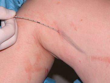 Die aszitestherapie stützt sich vor allem auf eine natriumarme ernährung und die gabe von aldosteronantagonisten. Varizenblutung . Facharzt Fur Chirurgie Und Gefasschirurgie Pd Dr Friedrich Reichenbach Therapie