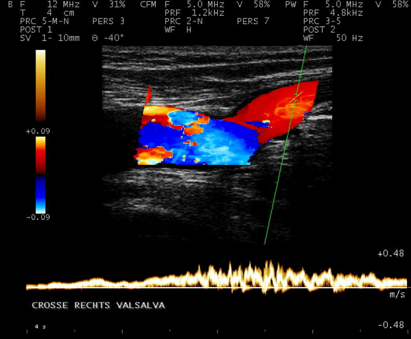 Beim Valsalva-Manöver (Bauchpresse) Farbumkehr im B-Bild und Ausschlag im cw-Doppler oberhalb der Nulllinie infolge langanhaltendem venösem Reflux ins Bein