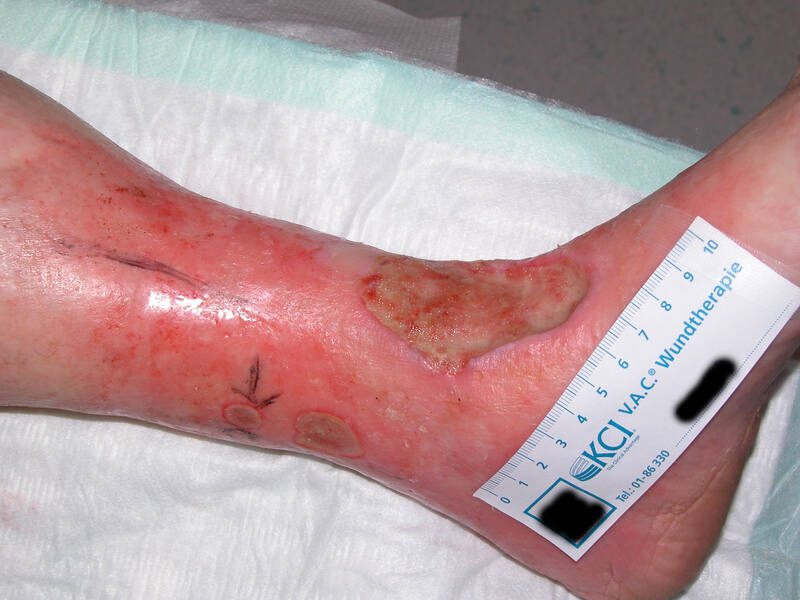 86 jährige Patientin mit 20 Jahre bestehenden Ulcera