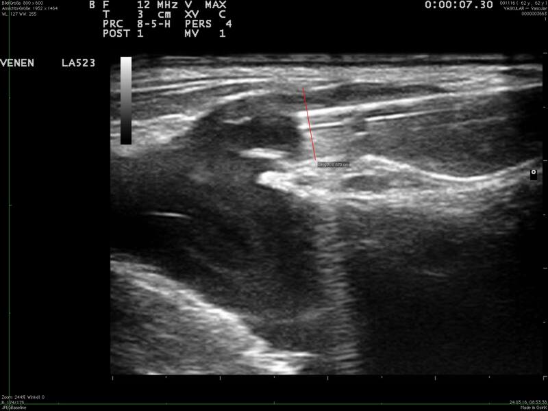 Platzierung des Radiofrequenzkatheters 1 cm vor Einmündung der Vena saphena magna in die Vena femoralis. Der Durchmesser der Vsm beträgt 7 mm.