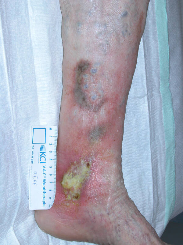 sowie Ulcus am Innenknöchel. Die histologische Untersuchung ergab ein Plattenepithelkarzinom.