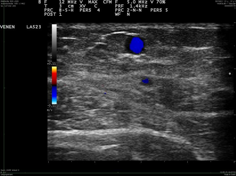 Doppelung mit variköser Vena saphena akzessoria medialis subkutan und normal weiter Vena saphena magna intrafaszial, beim Valsalva Reflux in beiden Ästen
