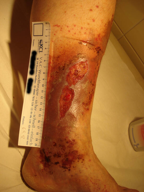 Stauungsdermatitis, Pigmentierung und Ulcera bei Insuffizienz der Vena saphena magna