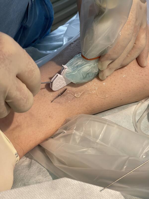 Punktion der Vsm unter sonographischer Kontrolle