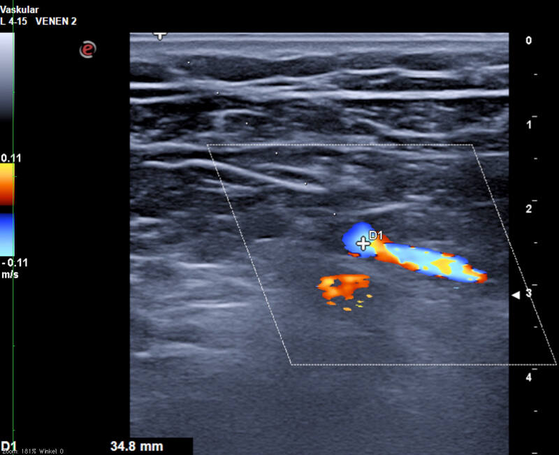Vena axillaris tief unter dem M. pectoralis, darunter die A. axillaris
