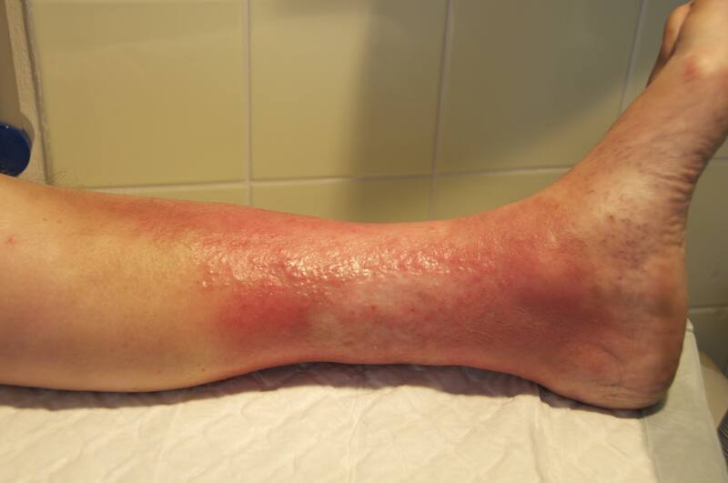 Floride Stauungsdermatitis