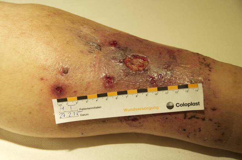 Stauungsdermatitis und multiple Ulcera bei Insuffizienz der Vena saphena magna