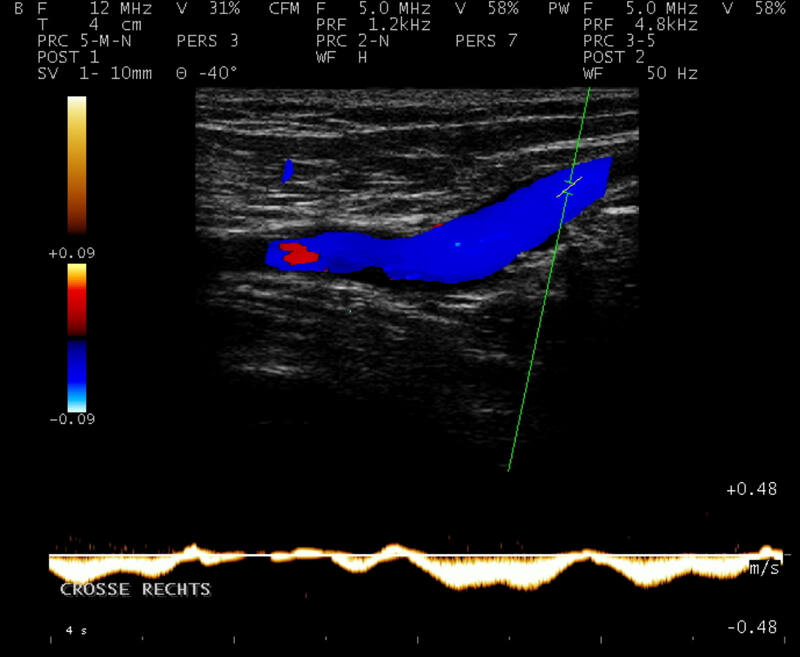 Befund bei Insuffizienz der Vena saphena magna. In Ruhe normaler atemmodulierter Fluß. Die blaue Farbkodierung im B-Bild und der Ausschlag unterhalb der Nulllinie im cw-Doppler entsprechen einem herzwärts gerichteten Blutfluß