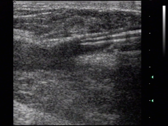 Sonographisch kontrollierte Platzierung der Katheterspitze 1 cm vor Einmündung der Vena saphena magna in die Vena femoralis