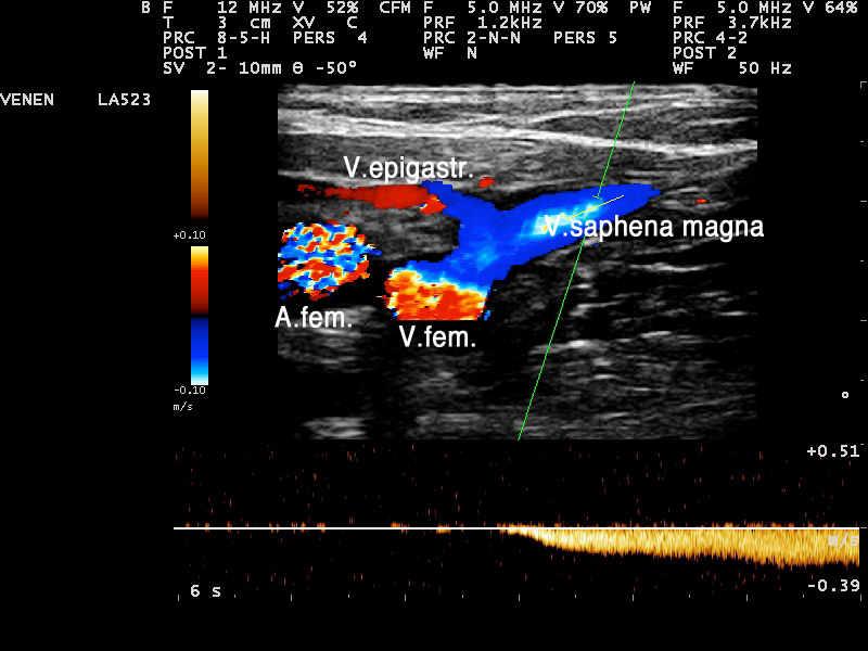 Normalbefund an der Einmündung der Vena saphena magna in die Vena femoralis ohne Reflux bei Bauchpresse