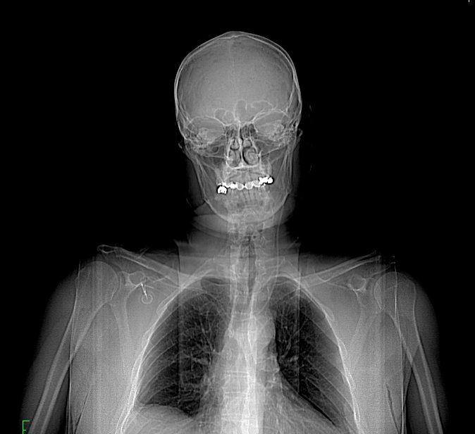 Fehlplatzierung eines rechtsseitigen Portkatheters über die Vena brachiocephalica in die linke Vena jugularis