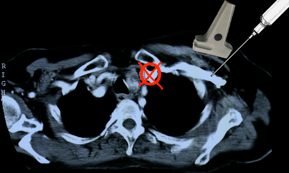 Statt der Vena subclavia intrathorakal wird die Vena axillaris extrathorakal punktiert