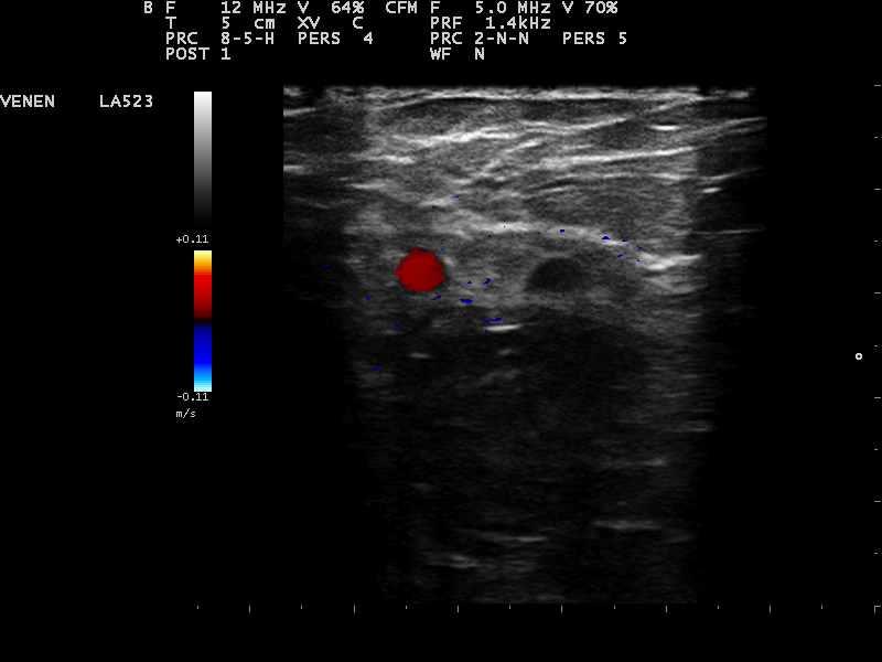 Bei Bauchpresse Reflux nur in einem Ast der doppelten Vsm